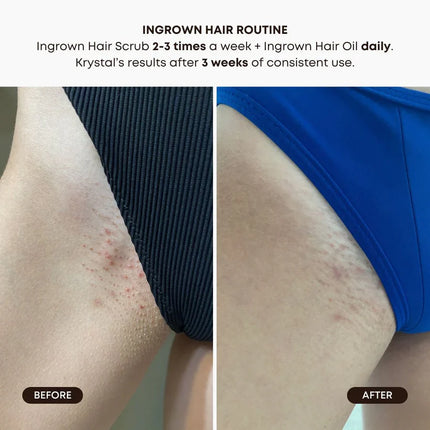 Bushbalm Ingrown Hair Oil - Watermelon Sugar