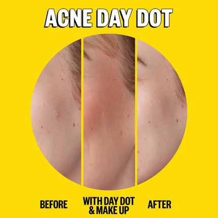 Peace Out Acne Day & Night Duo