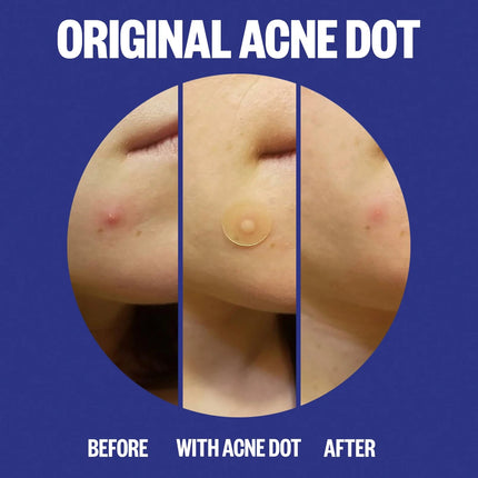 Peace Out Acne Day & Night Duo