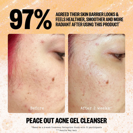 Peace Out Acne Gel Cleanser