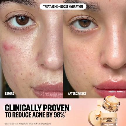 Peace Out Acne Gel Moisturizer
