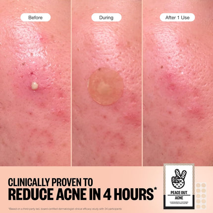 Peace Out Acne Healing Dots Jumbo