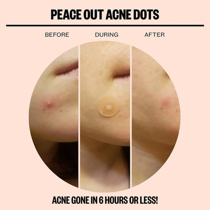 Peace Out Acne Healing Dots Jumbo