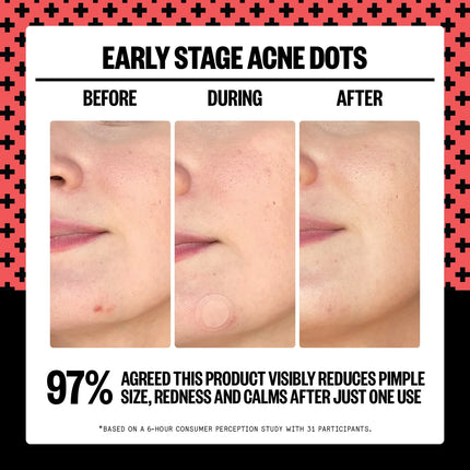Peace Out Early Stage Acne Dots