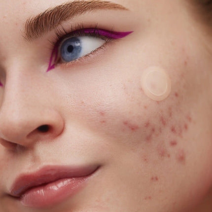 Peace Out Early Stage Acne Dots