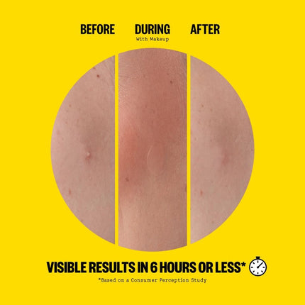 peace-out-skincare-acne-day-dots-5