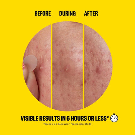 peace-out-skincare-acne-day-dots-6