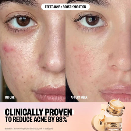 peace-out-skincare-acne-gel-moisturizer-3