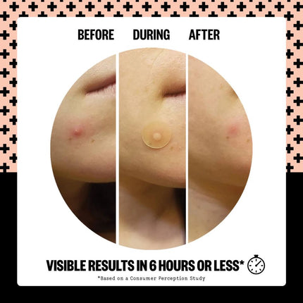 peace-out-skincare-acne-healing-dots-5