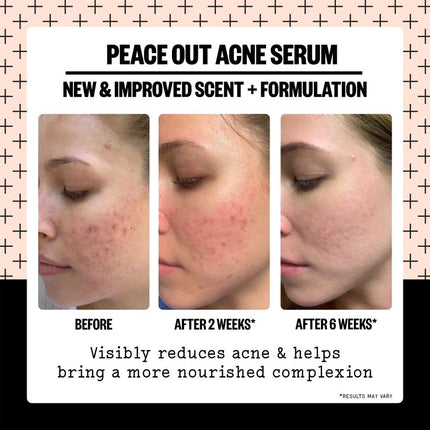 peace-out-skincare-acne-serum-3