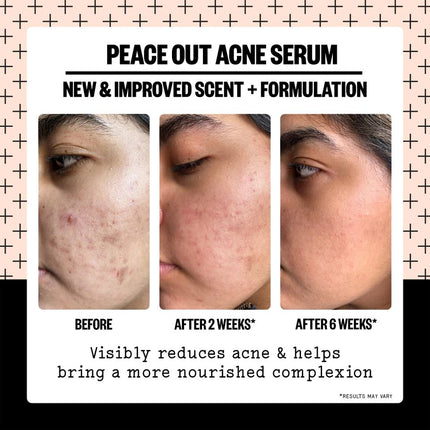 peace-out-skincare-acne-serum-5