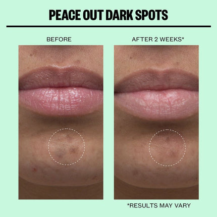 peace-out-skincare-dark-spots-microneedling-dots-3
